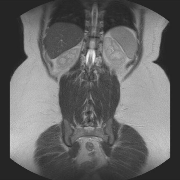 File:Normal liver MRI with Gadolinium (Radiopaedia 58913-66163 Coronal T2 33).jpg