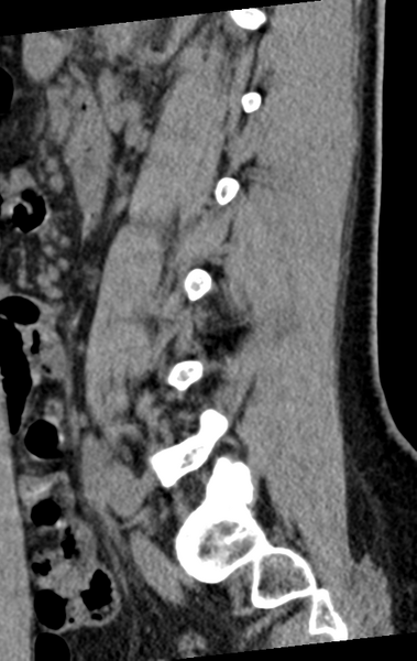 File:Normal lumbar spine CT (Radiopaedia 46533-50986 C 35).png