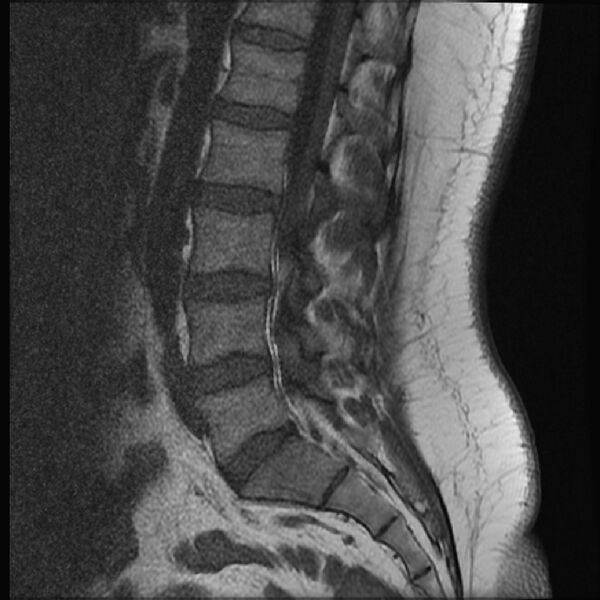File:Normal lumbar spine MRI (Radiopaedia 43051-46311 Sagittal T1 9).jpg