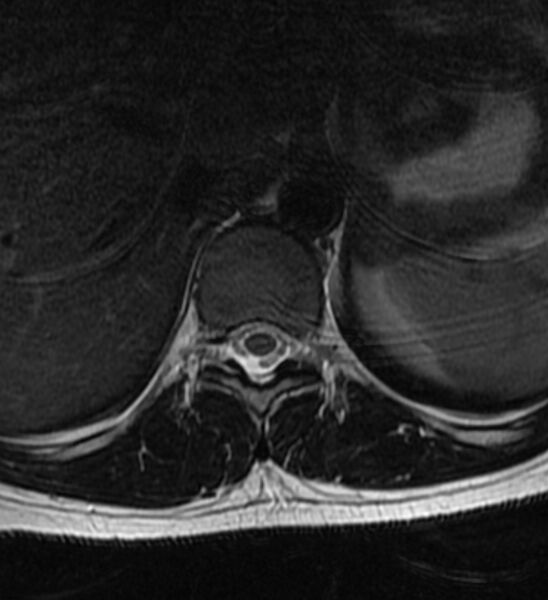 File:Normal thoracic spine MRI (Radiopaedia 41033-43781 Axial T2 18).jpg