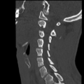 Normal trauma cervical spine (Radiopaedia 41017-43760 Sagittal bone window 30).png