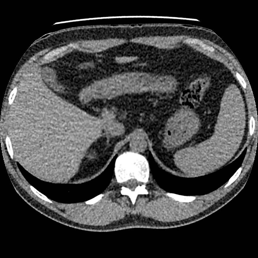 Obstructing ureteric calculus and ureteric anatomy (Radiopaedia 62730-71042 Axial non-contrast 3).jpg