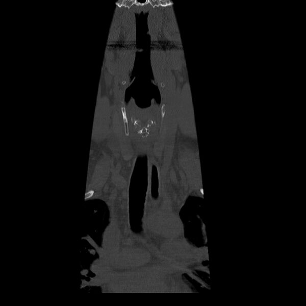 File:Occipital condyle fracture (Radiopaedia 31755-32691 Coronal bone window 1).jpg