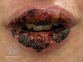 Stomatitis due to toxic epidermal necrolysis (DermNet NZ site-age-specific-ten-stomatitis).jpg