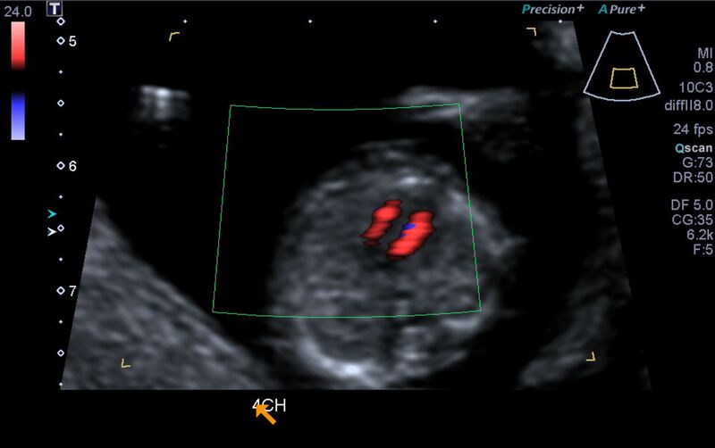 File:1st trimester nuchal-morphology ultrasound (Radiopaedia 44706-48477 Heart views cine with colour 82).jpg