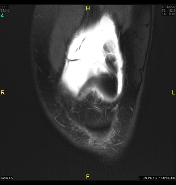 File:ACL mucoid degeration with cystic changes (Radiopaedia 48428-53341 Coronal PD fat sat 1).jpg