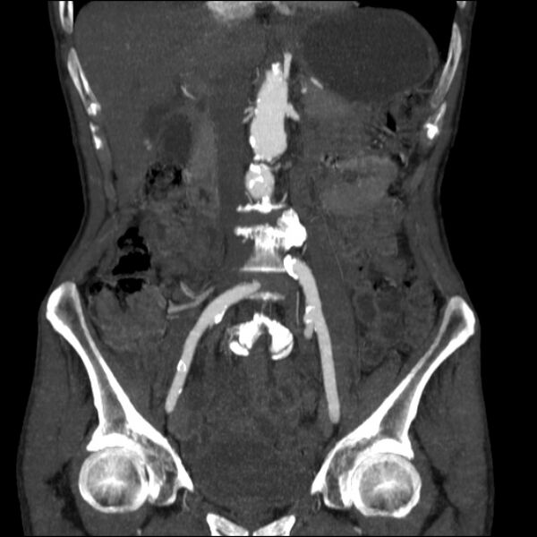 File:Abdominal aortic aneurysm (Radiopaedia 23703-23856 Coronal C+ arterial phase 12).jpg