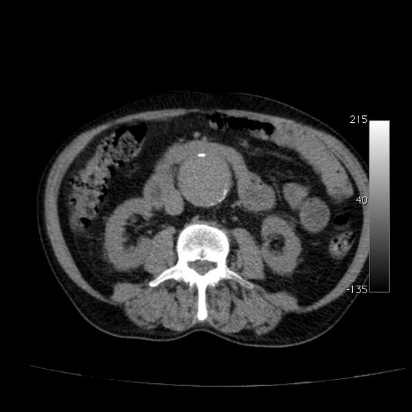 File:Abdominal aortic aneurysm (Radiopaedia 29248-29660 Axial non-contrast 28).jpg