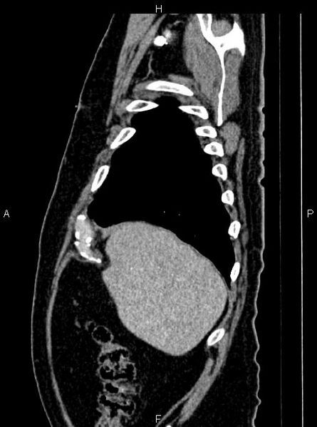 File:Abdominal aortic aneurysm (Radiopaedia 83094-97462 Sagittal renal cortical phase 22).jpg