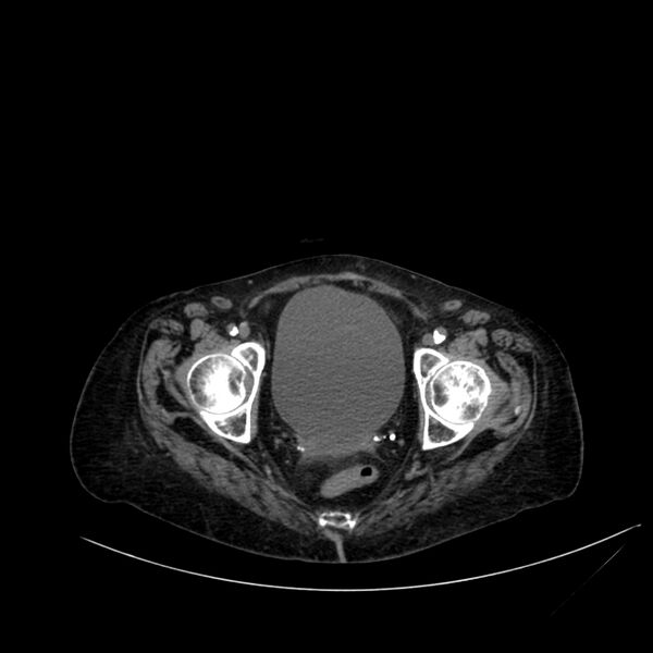 File:Abdominal aortic aneurysm - impending rupture (Radiopaedia 19233-19246 Axial non-contrast 116).jpg