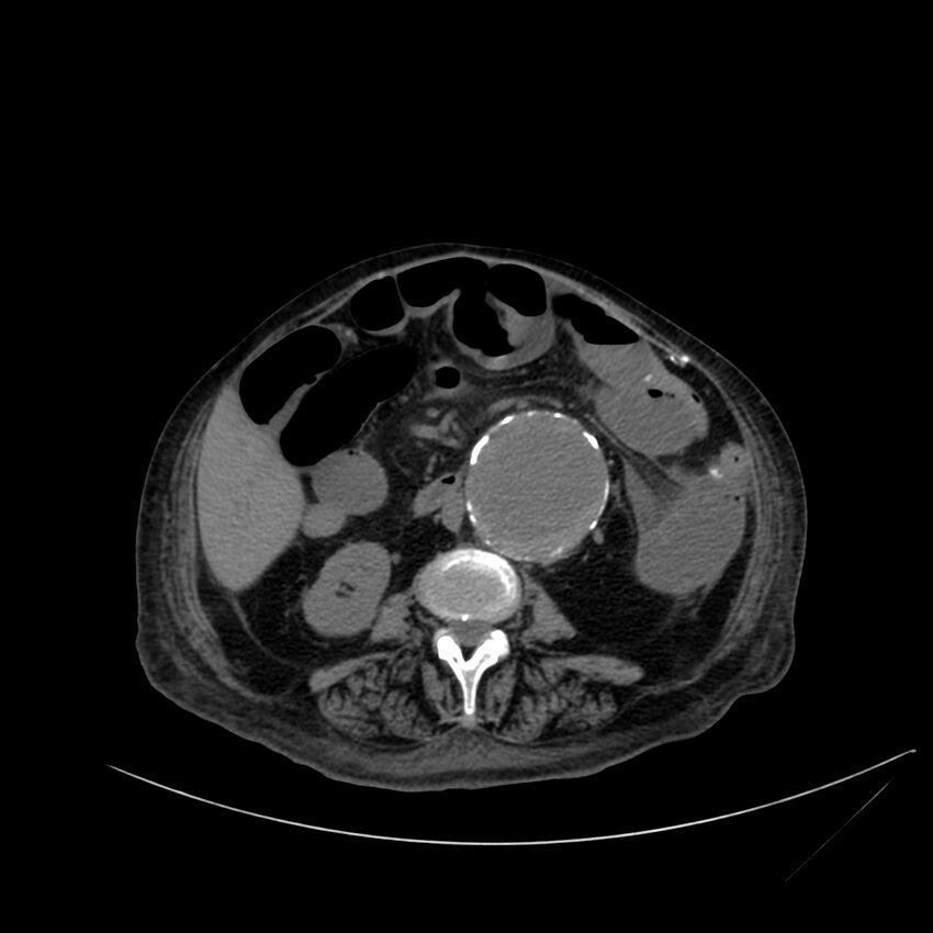 Abdominal aortic aneurysm - impending rupture (Radiopaedia 19233-19246 Axial non-contrast 67).jpg