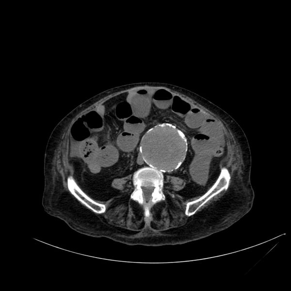 File:Abdominal aortic aneurysm - impending rupture (Radiopaedia 19233-19246 Axial non-contrast 79).jpg