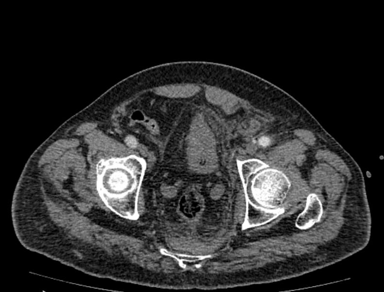 File:Abdominal aortic aneurysm rupture (Radiopaedia 54179-60362 Axial C+ arterial phase 51).jpg