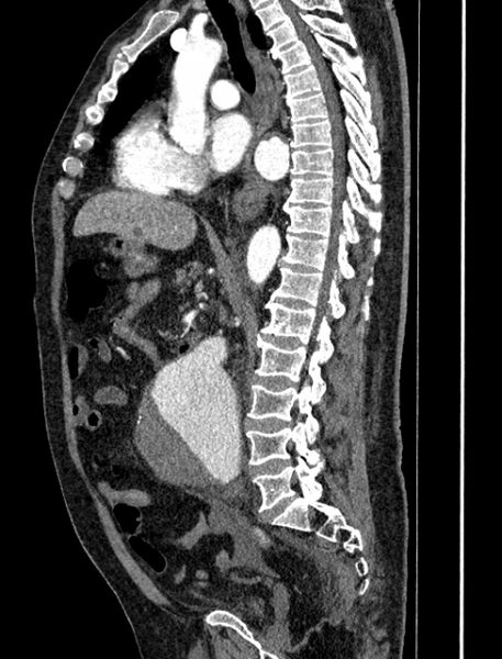 File:Abdominal aortic aneurysm rupture (Radiopaedia 54179-60362 Sagittal C+ arterial phase 20).jpg