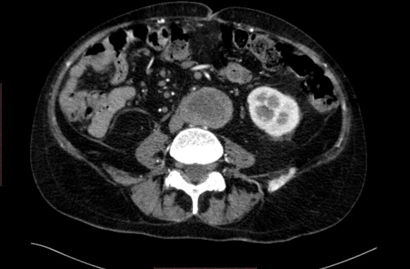 File:Abdominal aortic interposition tube graft and aneurysm thrombosis (Radiopaedia 71438-81857 Axial C+ arterial phase 106).jpg