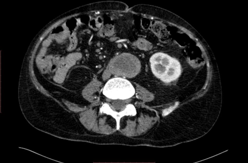 Abdominal aortic interposition tube graft and aneurysm thrombosis (Radiopaedia 71438-81857 Axial C+ arterial phase 106).jpg