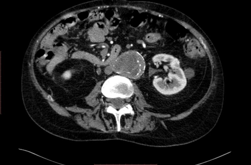 File:Abdominal aortic interposition tube graft and aneurysm thrombosis (Radiopaedia 71438-81857 Axial C+ arterial phase 80).jpg