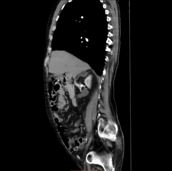 File:Abdominal aortic interposition tube graft and aneurysm thrombosis (Radiopaedia 71438-81857 Sagittal C+ arterial phase 22).jpg