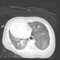 Aberrant left pulmonary artery (pulmonary sling) (Radiopaedia 42323-45435 Axial lung window 26).jpg