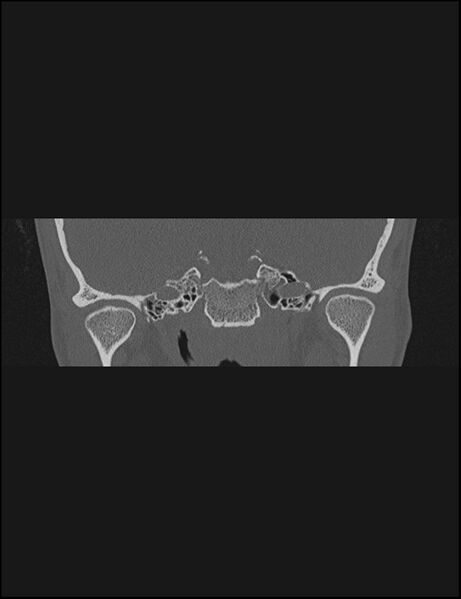 File:Aberrant right internal carotid artery (Radiopaedia 65191-74198 Coronal non-contrast 27).jpg