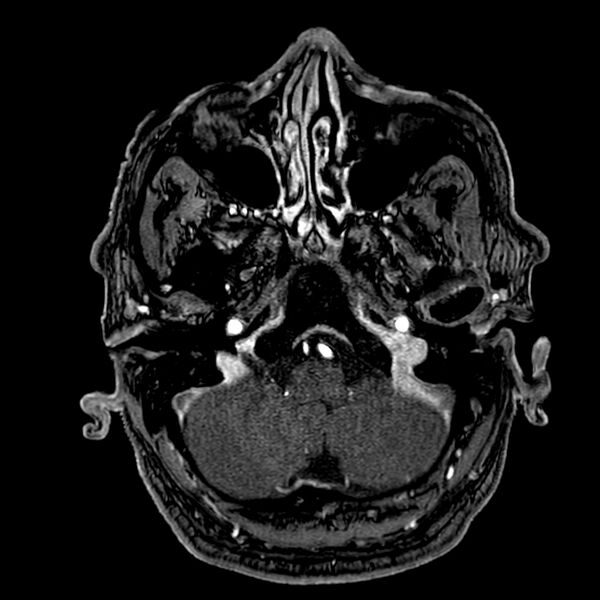 File:Accessory middle cerebral artery (Radiopaedia 73114-83828 Axial MRA 18).jpg
