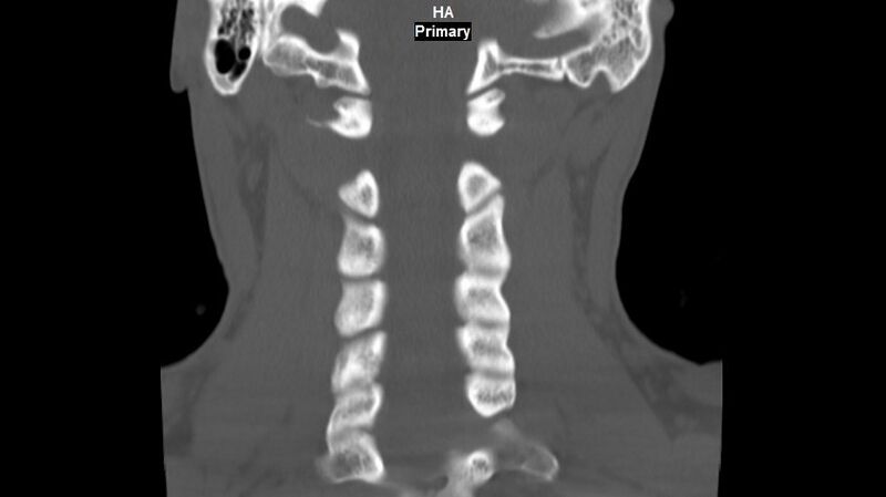 File:Accessory ossicle of the anterior arch of C1 vertebra (Radiopaedia 58149-65211 Coronal bone window 10).jpg