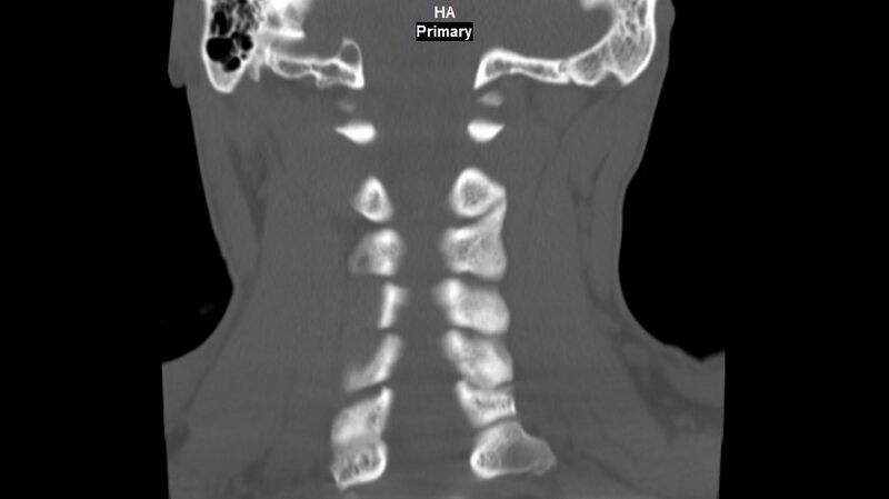 File:Accessory ossicle of the anterior arch of C1 vertebra (Radiopaedia 58149-65211 Coronal bone window 11).jpg