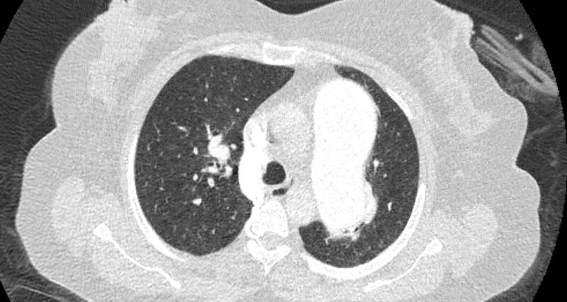 File:Accessory right inferior hepatic vein (Radiopaedia 65245-74259 Axial lung window 19).jpg