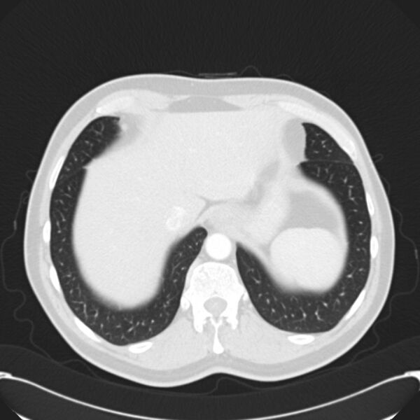 File:Achalasia (Radiopaedia 24937-25206 Axial lung window 29).jpg