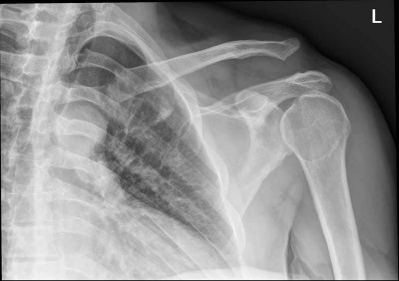 File:Acromioclavicular joint injury (type V) (Radiopaedia 44768-48582 Frontal 1).png