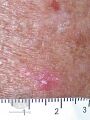 Actinic Keratoses affecting the legs and feet (DermNet NZ lesions-ak-legs-499).jpg