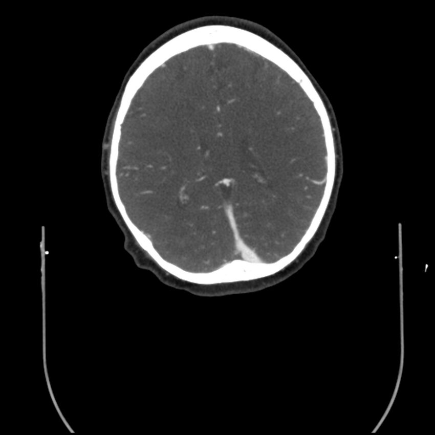 Acute M1 occlusion with ischemic penumbra (CT perfusion) (Radiopaedia 71897-82344 Axial C+ arterial phase thins 25).jpg
