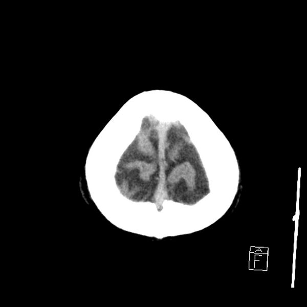 File:Acute P1 occlusion with PCA ischemia penumbra (CT perfusion) (Radiopaedia 72084-82586 Axial non-contrast 44).jpg
