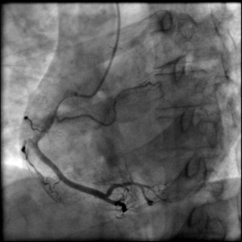 Acute anteroseptal myocardial infarction (Radiopaedia 68409-77946 RAO straight RCA 41).jpg