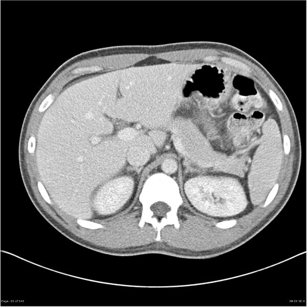 File:Acute appendicitis (Radiopaedia 25364-25615 B 12).jpg