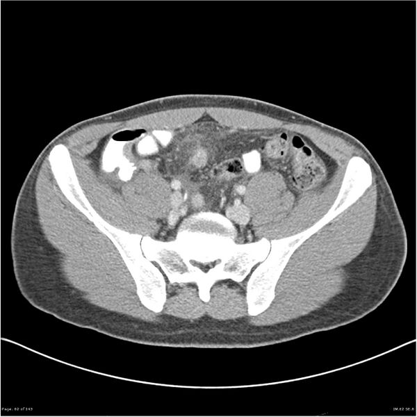 File:Acute appendicitis (Radiopaedia 25364-25615 B 52).jpg