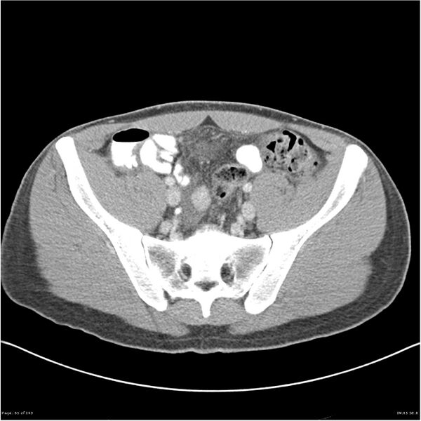 File:Acute appendicitis (Radiopaedia 25364-25615 B 55).jpg