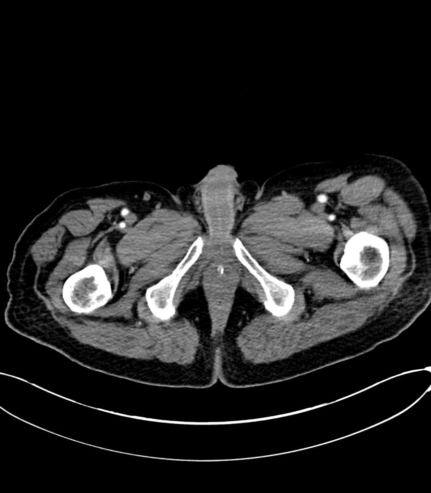 Acute arterial mesenteric ischemia (Radiopaedia 78238-90828 Axial C+ arterial phase 152).jpg