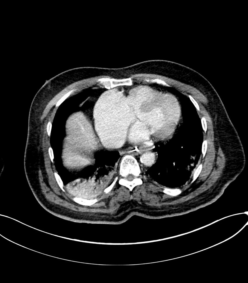 Acute arterial mesenteric ischemia (Radiopaedia 78238-90828 Axial C+ portal venous phase 13).jpg