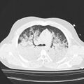 Acute aspiration pneumonitis (Radiopaedia 33605-34703 Axial lung window 38).jpg