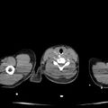 Acute aspiration pneumonitis (Radiopaedia 33605-34703 Axial non-contrast 6).jpg