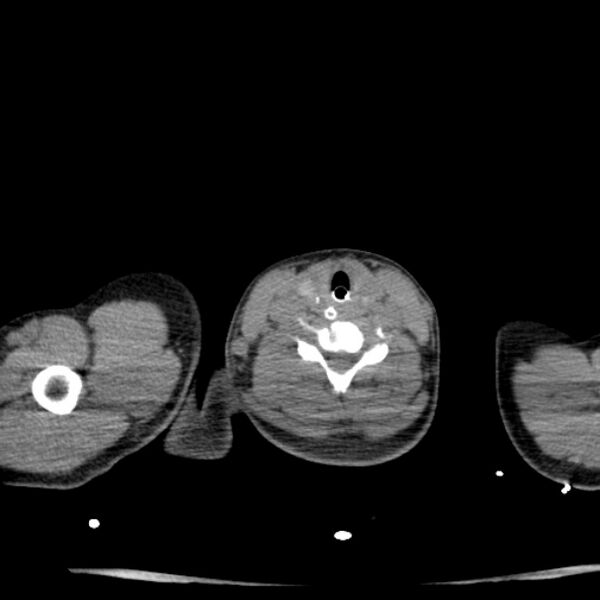 File:Acute aspiration pneumonitis (Radiopaedia 33605-34703 Axial non-contrast 6).jpg