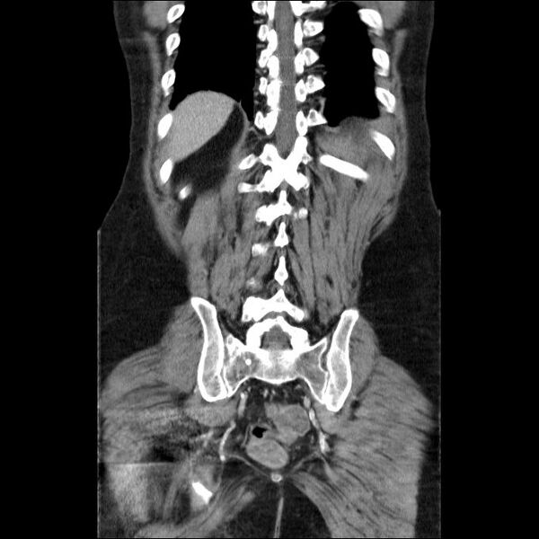 File:Acute cholecystitis and incidental left sided IVC (Radiopaedia 49352-54459 Coronal C+ portal venous phase 17).jpg