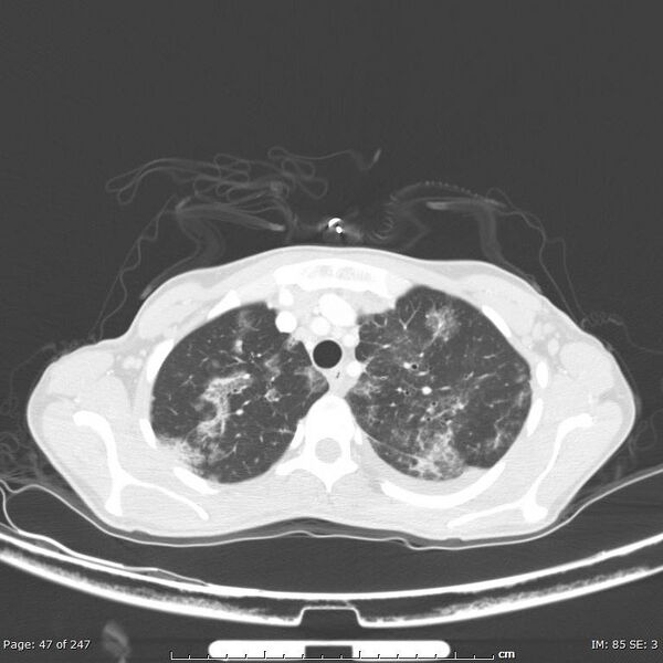 File:Acute eosinophilic pneumonia (Radiopaedia 48211-53073 Axial 31).jpg