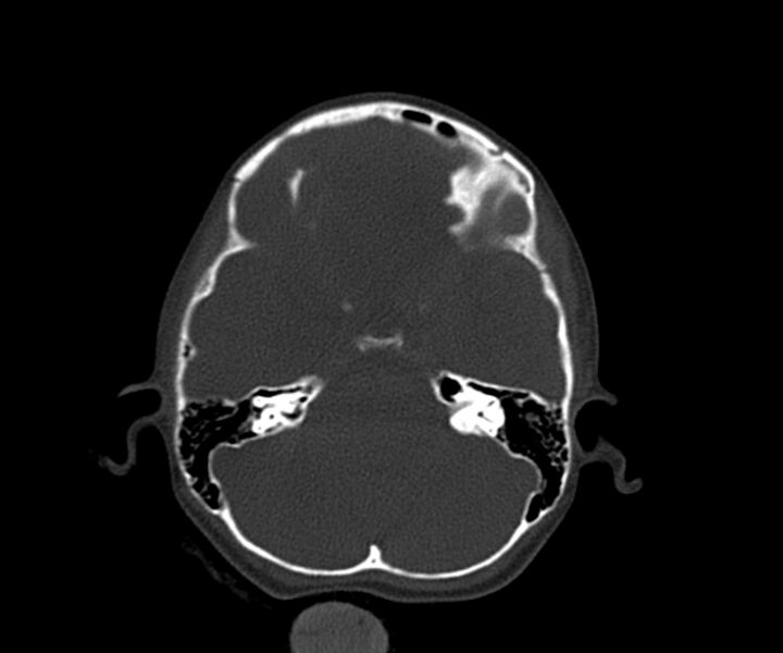 File:Acute epidural hematoma (Radiopaedia 63659-72335 Axial bone window 7).jpg