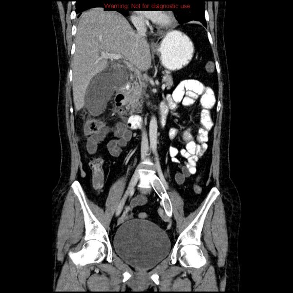 File:Acute gangrenous cholecystitis (Radiopaedia 10123-10661 Coronal C+ portal venous phase 16).jpg