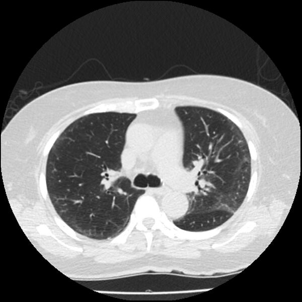 File:Acute interstitial pneumonitis (Radiopaedia 45404-49444 Axial lung window 42).jpg