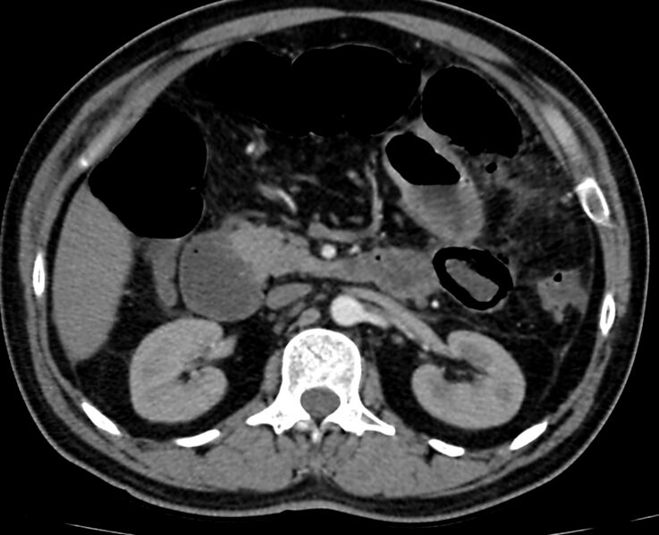 File:Acute mesenteric ischemia - superior mesenteric artery thrombosis (Radiopaedia 73947-84776 Axial C+ arterial phase 37).jpg