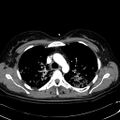 Acute myocardial infarction in CT (Radiopaedia 39947-42415 Axial C+ arterial phase 40).jpg