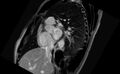 Acute myocarditis (Radiopaedia 77023-88967 Short axis stack LGE 12).jpg